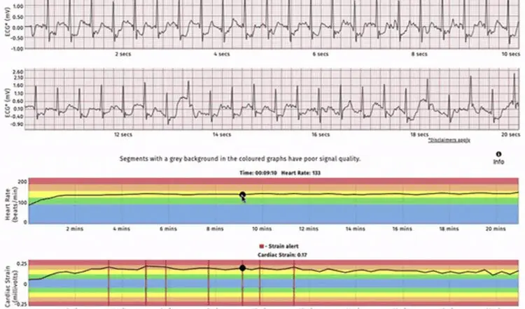 ECG graphs
